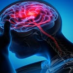 Why does Increased Exercise Decrease Migraine?